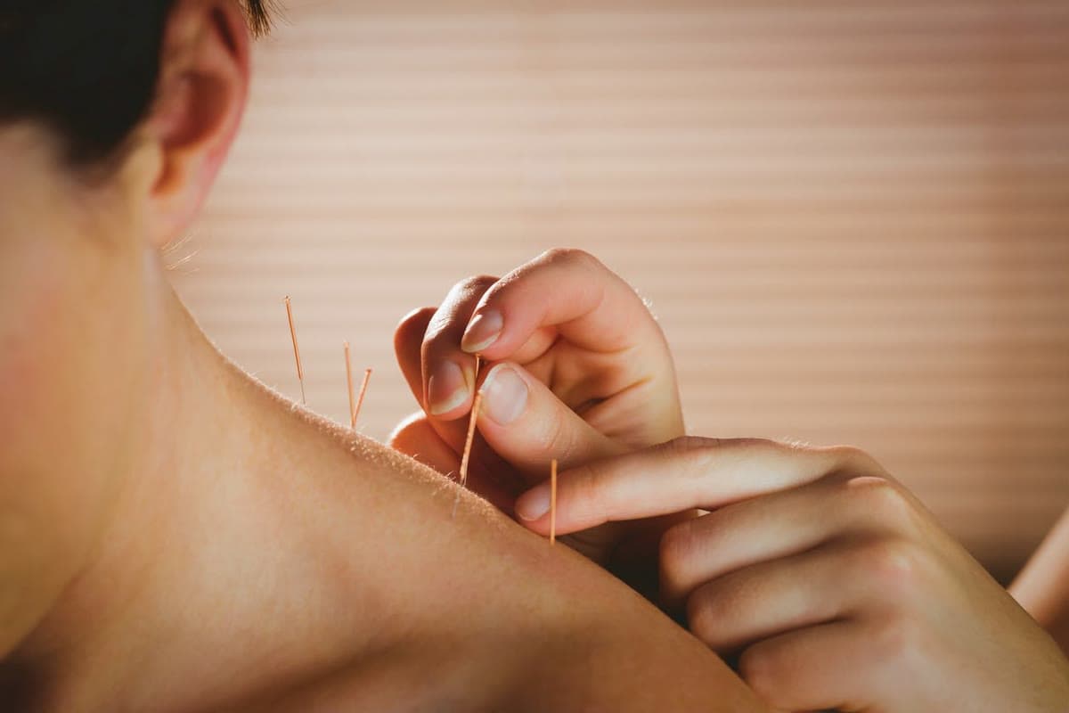 Physiotherapist placing fine dry needles into the shoulder muscles